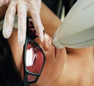 Laserska epilacija gornje usne: učinkovit postupak u borbi protiv dosadnih dlačica